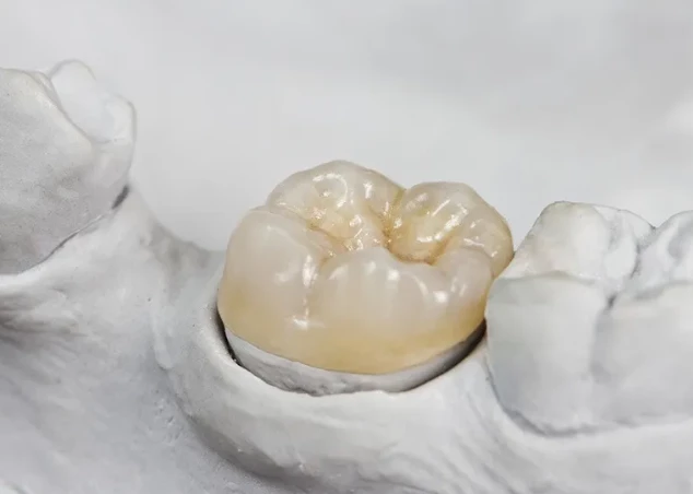 10-general dentistry-dental-onlays-inlays