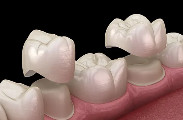 3 - What are Dental Crowns?