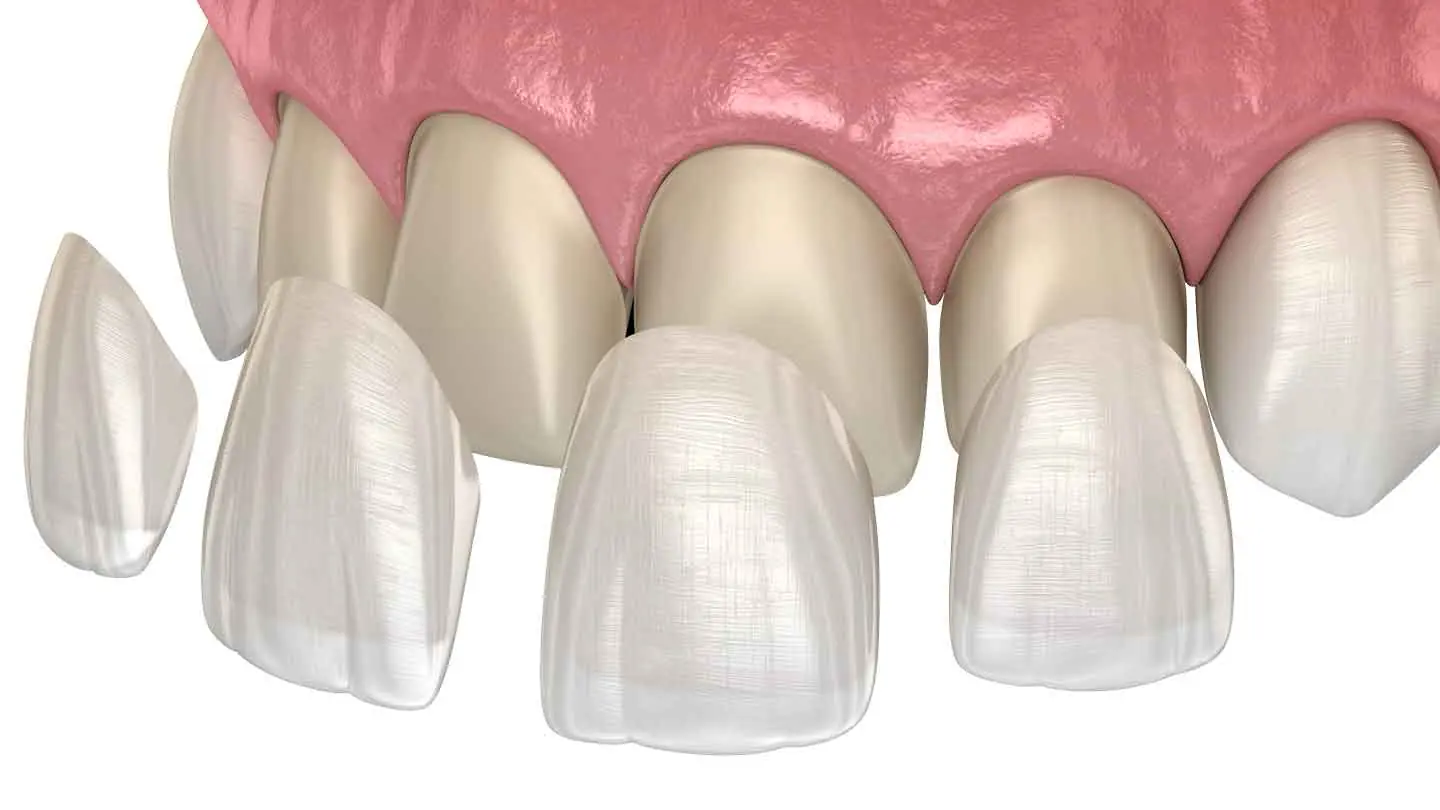 4 - Ceramic Veneers - veneers-3d-illustration
