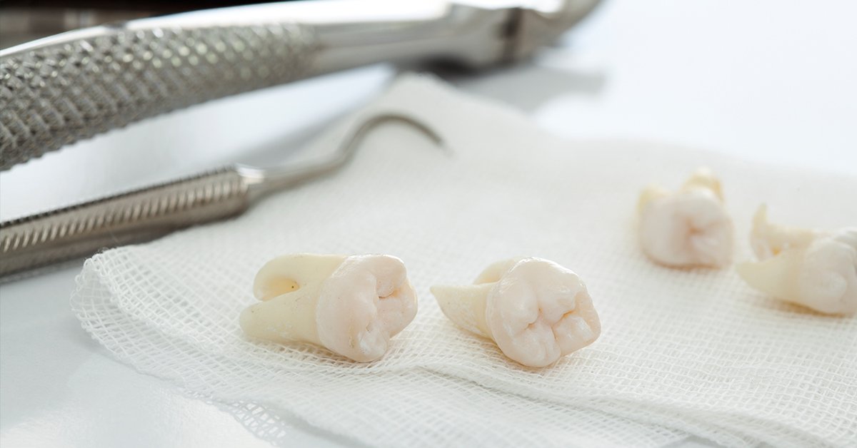 Preparing for a Tooth Extraction