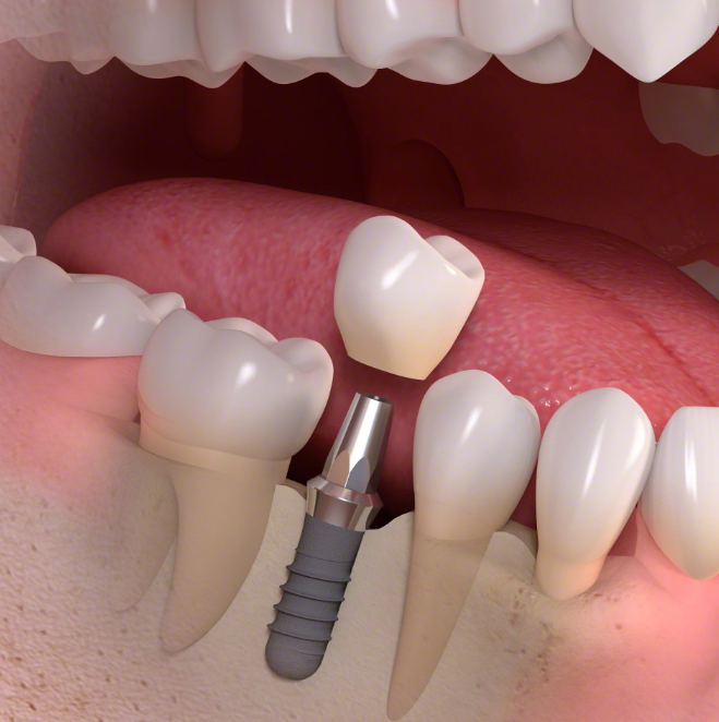 Single tooth implant