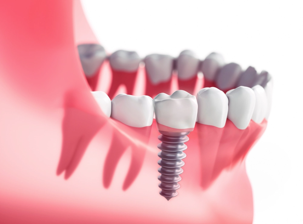 Dental Implants Rock Hill SC - Dentist