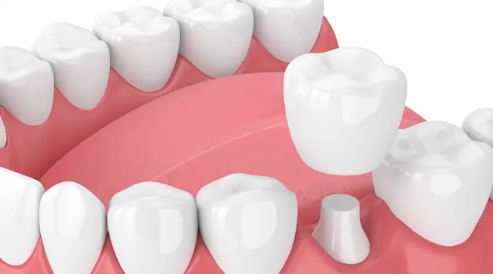 video-thumbnail-dental-crowns